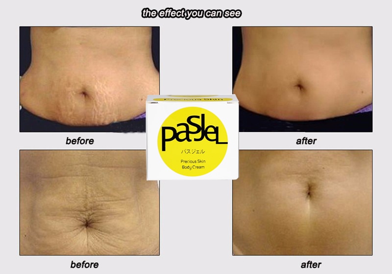 1piece-Pasjel-Cream-For-Stretch-Marks-And-Scar-Removal-Powerful-To-Stretch-Marks--Maternity-Skin-Bod-32874705621